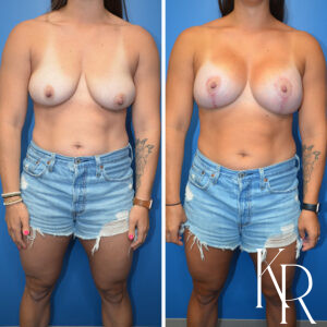 Before and after breast lift and breast augmentation