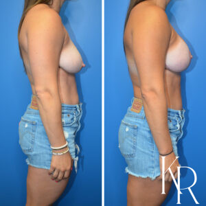 Before and after breast lift and breast augmentation