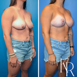 Before and after breast lift and breast augmentation