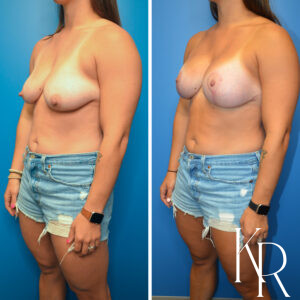 Before and after breast lift and breast augmentation