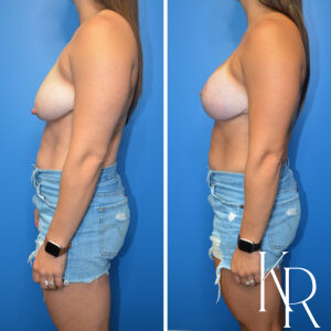 Before and after breast lift and breast augmentation