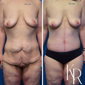 Before and after Fluer de lis abdominoplasty