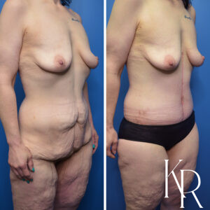 Before and after Fluer de lis abdominoplasty