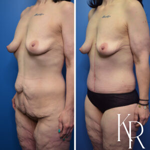 Before and after Fluer de lis abdominoplasty