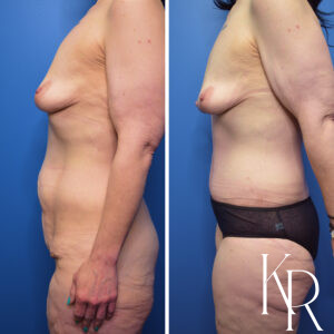 Before and after Fluer de lis abdominoplasty