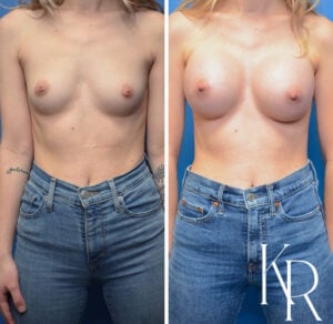 Before and after inverted nipple repair and a breast augmentation