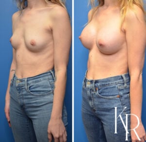 Before and after inverted nipple repair and a breast augmentation