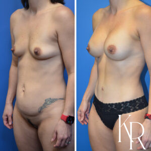 Before and after a mommy makeover.