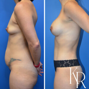 Before and after a mommy makeover.