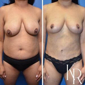 Before and after a mommy makeover.