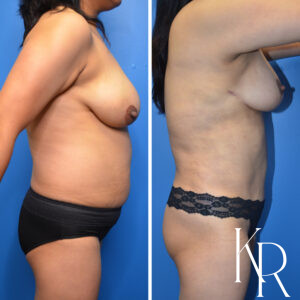 Before and after a mommy makeover.