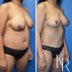 Before and after a mommy makeover.