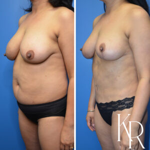 Before and after a mommy makeover.