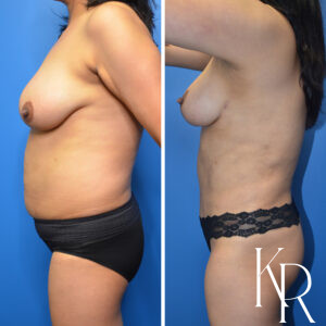 Before and after a mommy makeover.