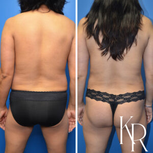 Before and after a mommy makeover.