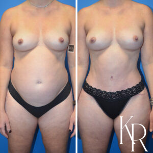 Before and after a mommy makeover.