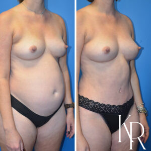 Before and after a mommy makeover.