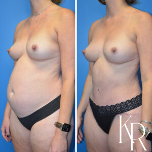 Before and after a mommy makeover.