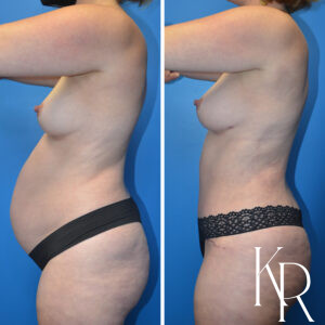 Before and after a mommy makeover.