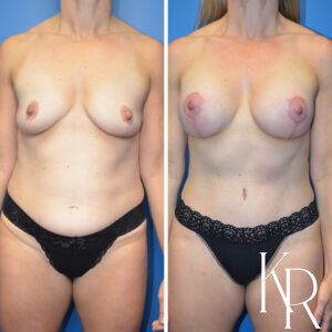 Before and after a mommy makeover.