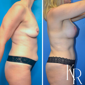 Before and after a mommy makeover.
