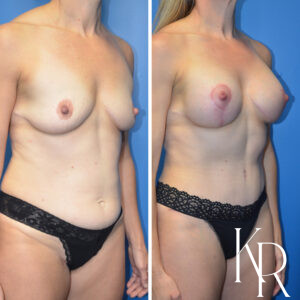 Before and after a mommy makeover.