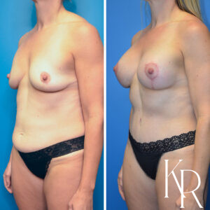 Before and after a mommy makeover.