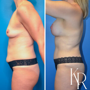 Before and after a mommy makeover.