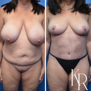 Before and after a mommy makeover.