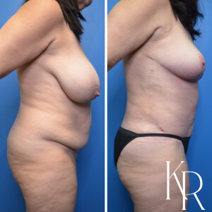 Before and after a mommy makeover.