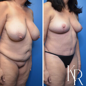 Before and after a mommy makeover.
