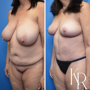 Before and after a mommy makeover.