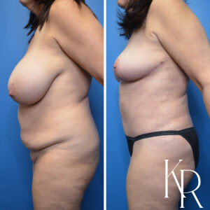 Before and after a mommy makeover.