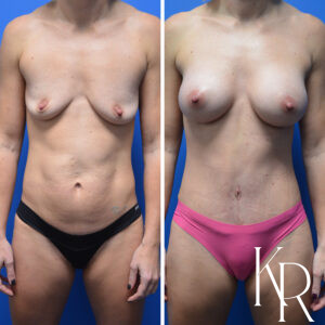 Before and after a mommy makeover.