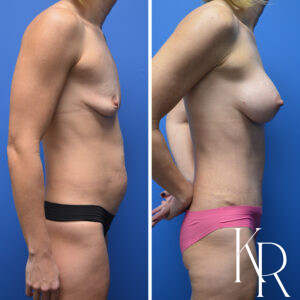 Before and after a mommy makeover.