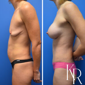 Before and after a mommy makeover.