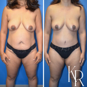 Before and after a mommy makeover.
