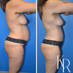 Before and after a mommy makeover.