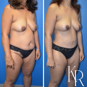 Before and after a mommy makeover.