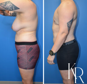 Before and after top surgery