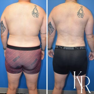 Before and after top surgery