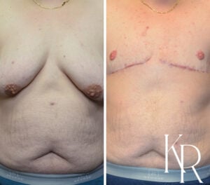 Before and after top surgery