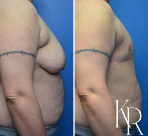 Before and after top surgery