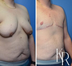 Before and after top surgery