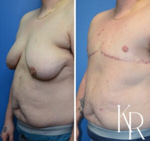 Before and after top surgery