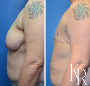 Before and after top surgery