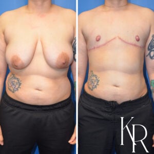Before and after top surgery