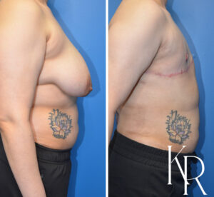 Before and after top surgery