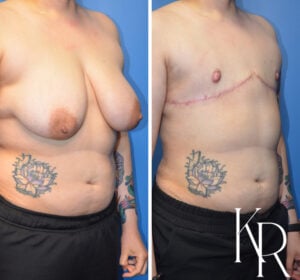 Before and after top surgery