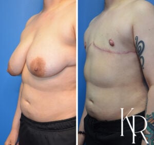 Before and after top surgery